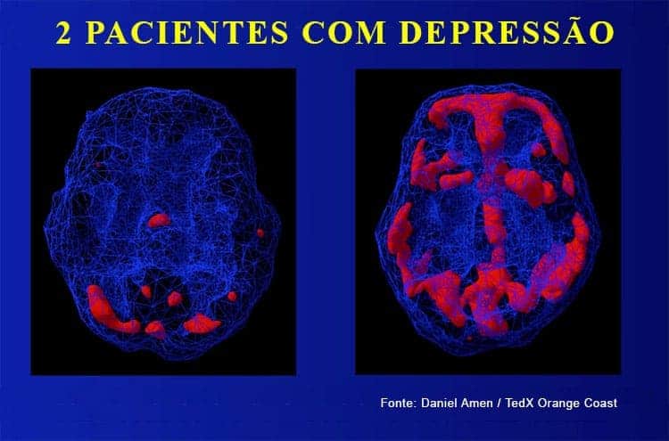 Scan cerebral comprova que causa da Ansiedade e da Depressão pode ser diferente de pessoa para pessoa